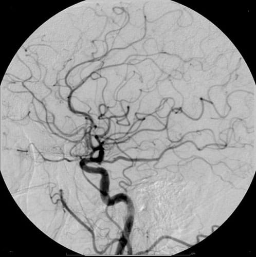 angiography